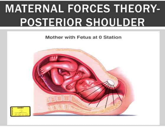 MATERNAL FORCES THEORY-POSTERIOR SHOULDER
