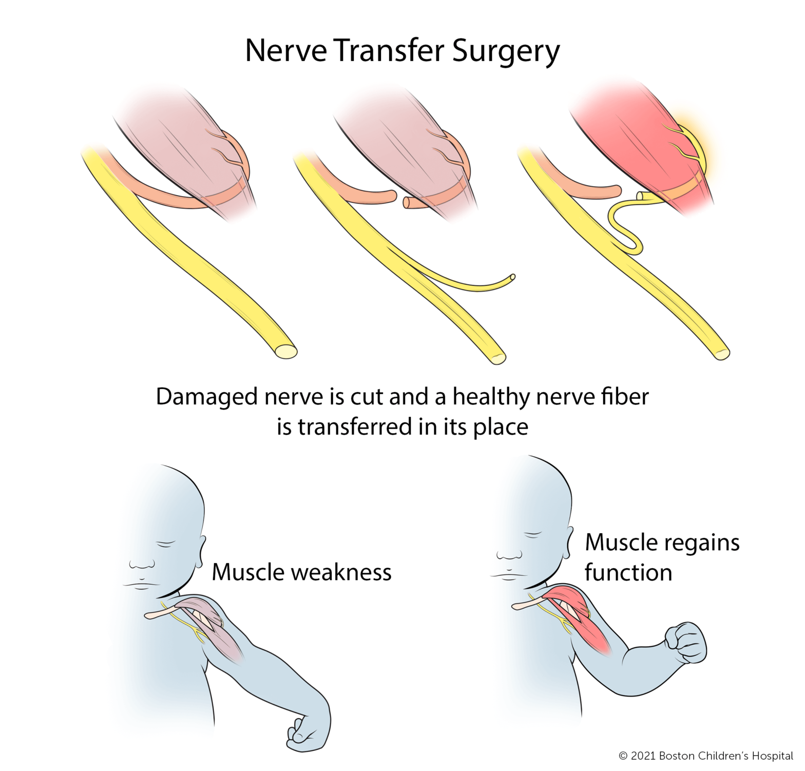 Common Risks & Complications of Compensation Nerve Grafting Surgery in